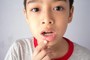 Child showing that he has a canker sore.