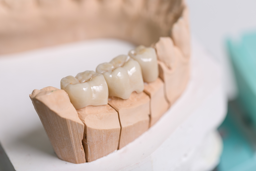 Tooth Replacement Options Compared Oak Harbor Dentists